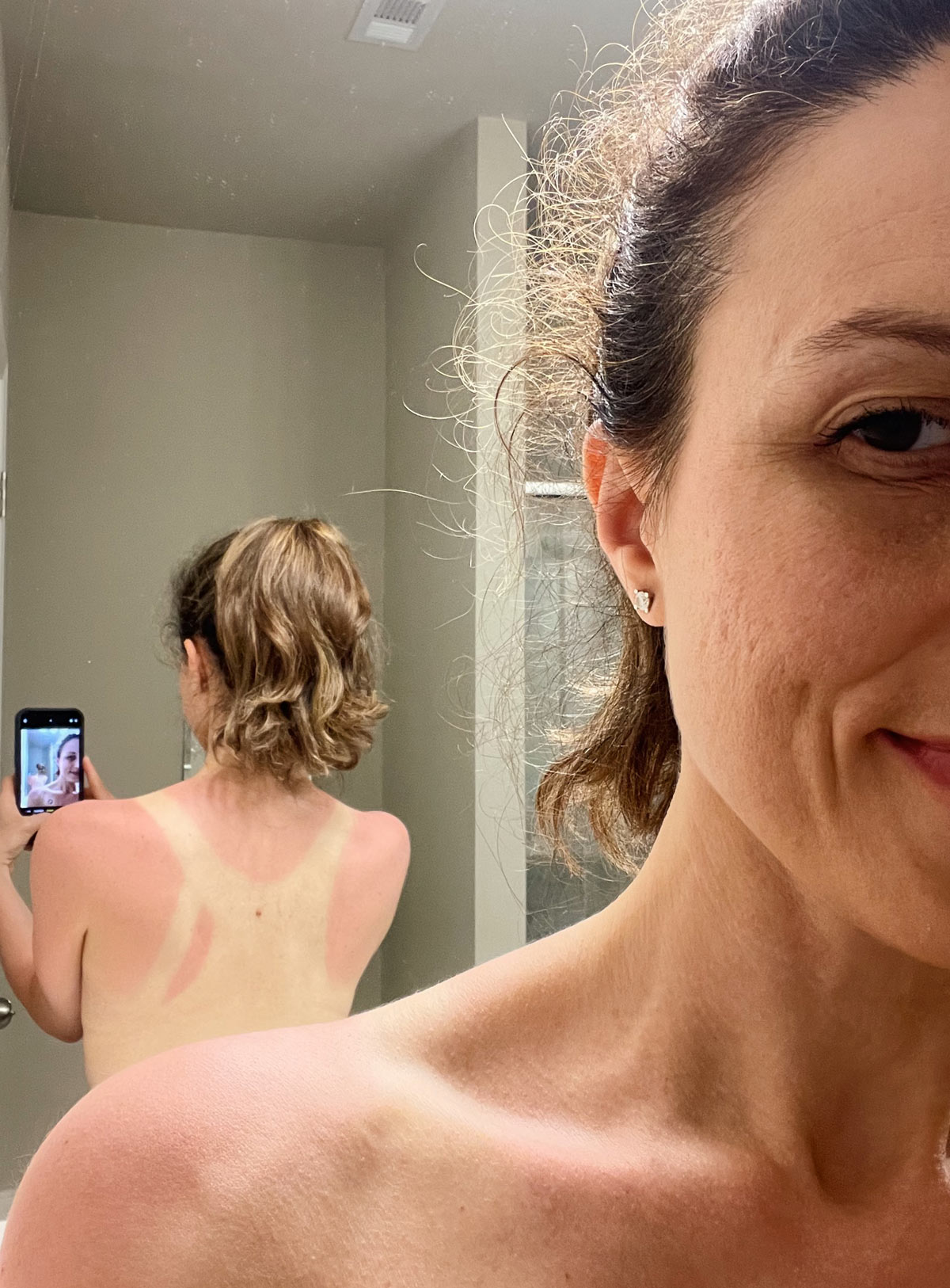 Aysegul taking a photo of her sunburnt back with her phone
